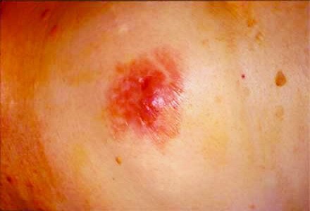 Nipple Dermatitis in Adults: Condition, Treatments, and ...